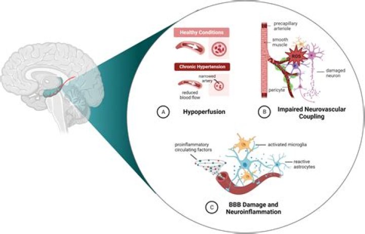 What does it mean to have a small hippocampus